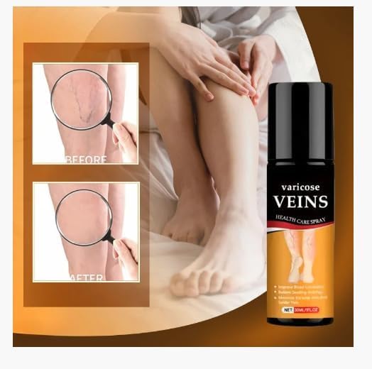 Varicose Veins Spray