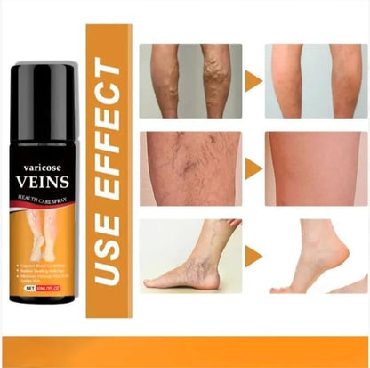 Varicose Veins Spray